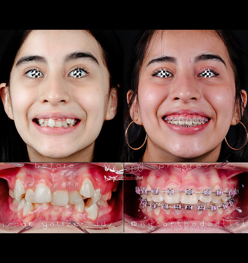 Front view of patient's smle and closeup before and after orthodontic crowding treatment