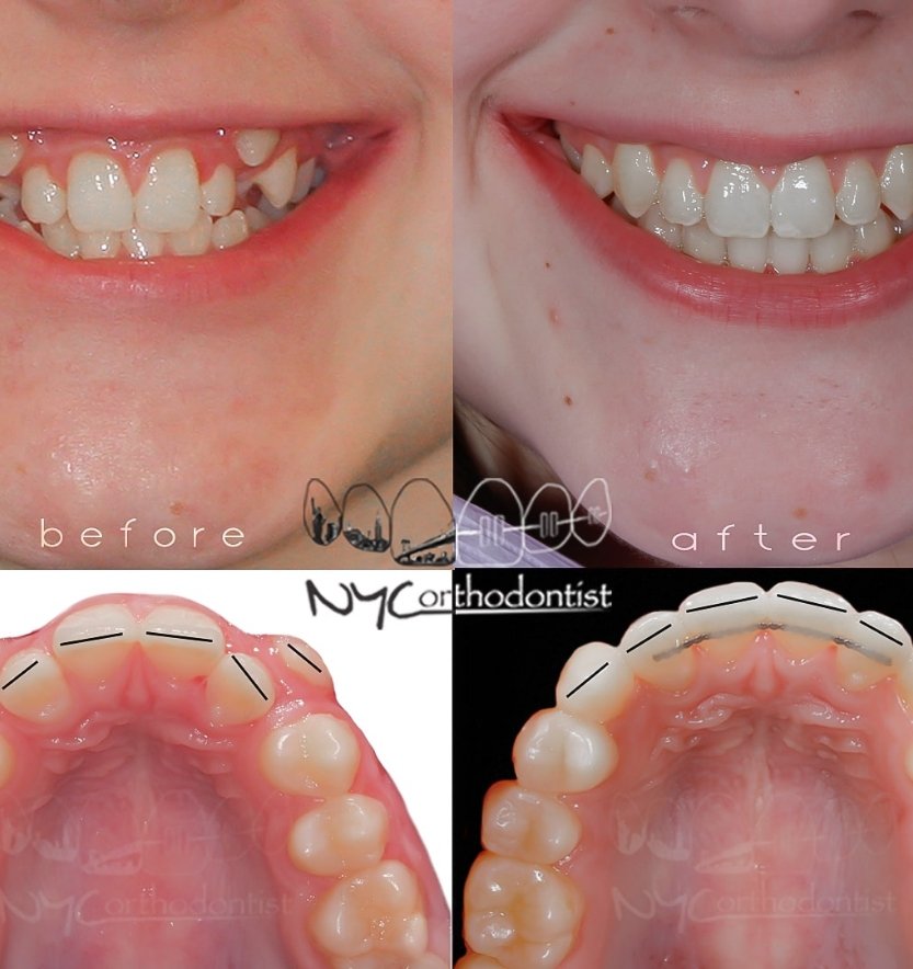 Closeup of smile before and after orthodontic crowding treatment