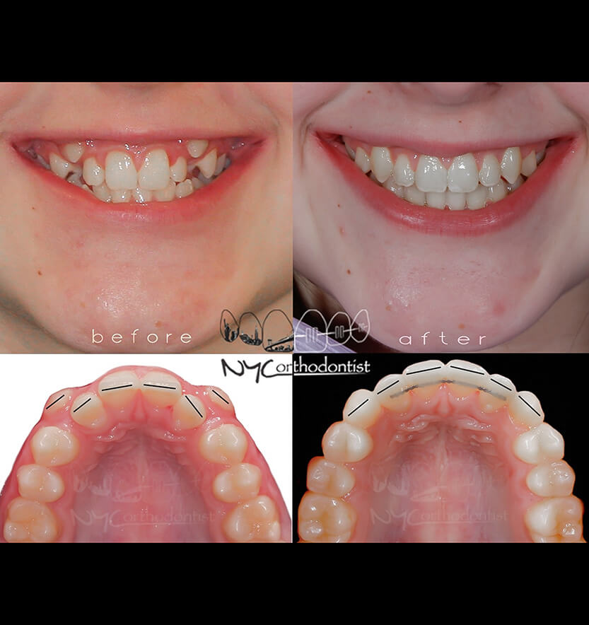 Closeup of smile before and after orthodontic crowding treatment