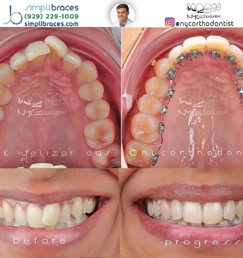 Young patient's smile before and after orthodontic crowding treatment