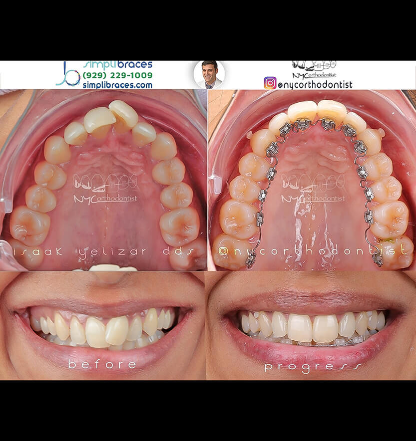 Young patient's smile before and after orthodontic crowding treatment