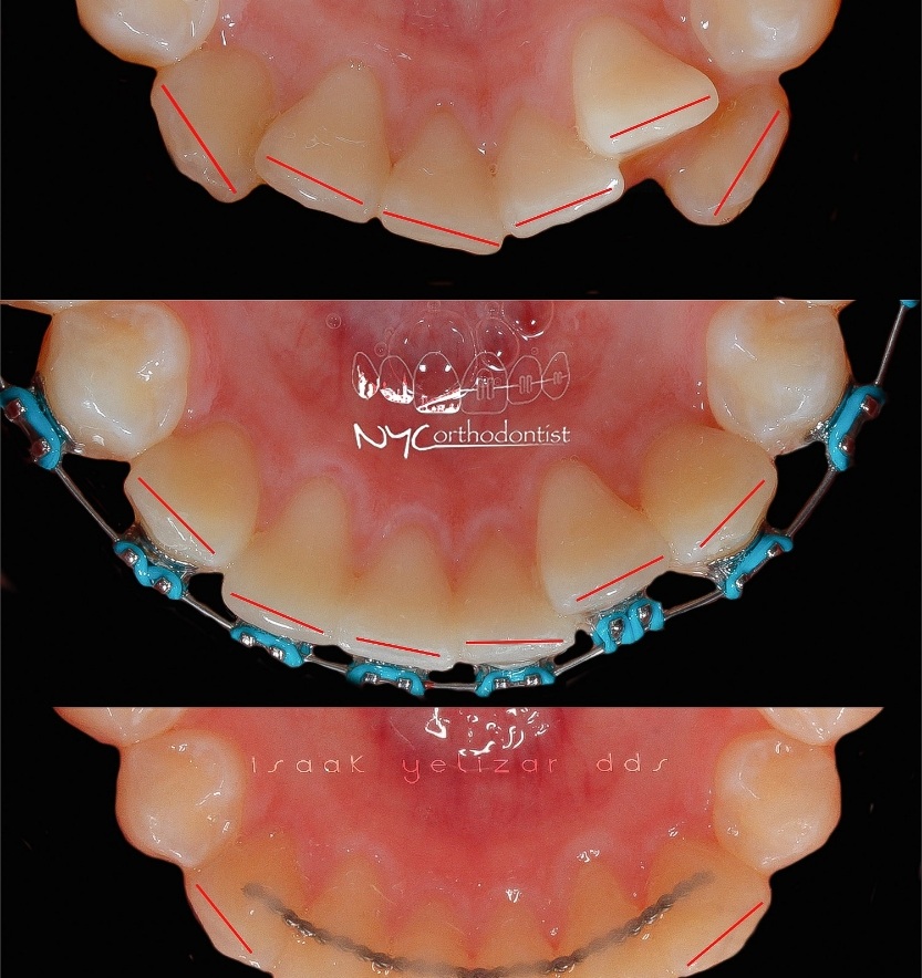Bottom inside of teeth and front view of smile before and after orthodontic crowding treatment