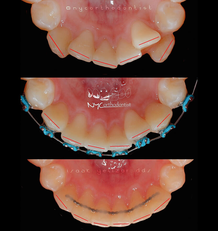 Bottom inside of teeth and front view of smile before and after orthodontic crowding treatment