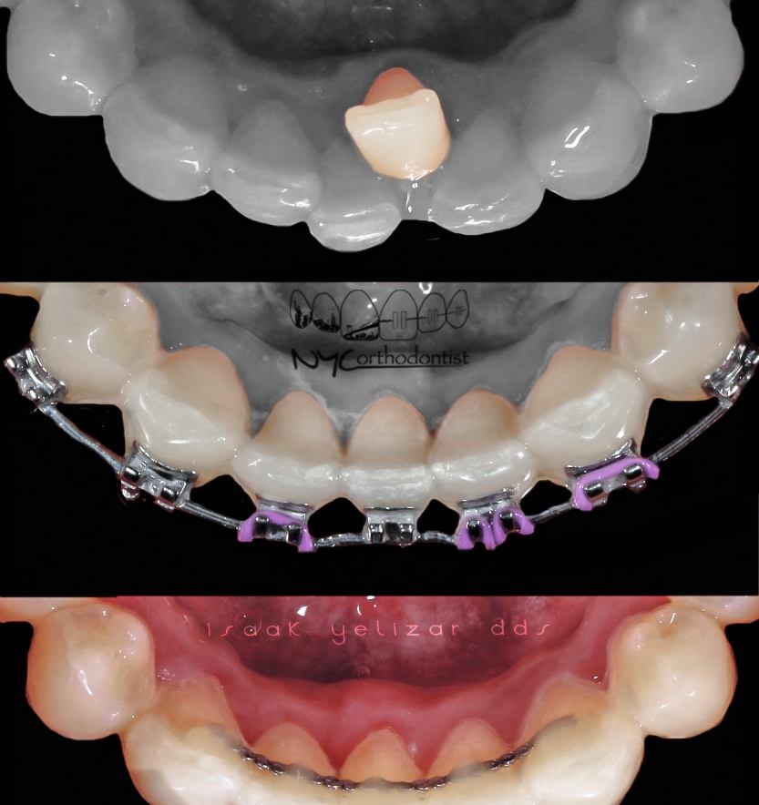 Inside of bottom teeth before during and after orthodontic crowding treatment