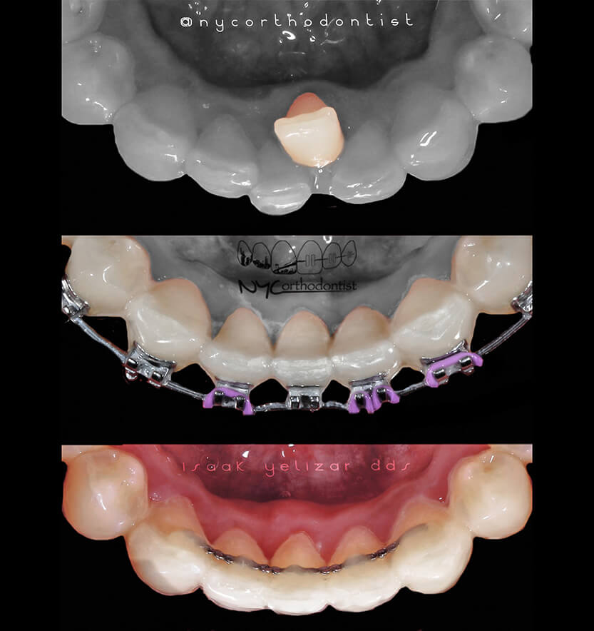 Inside of bottom teeth before during and after orthodontic crowding treatment