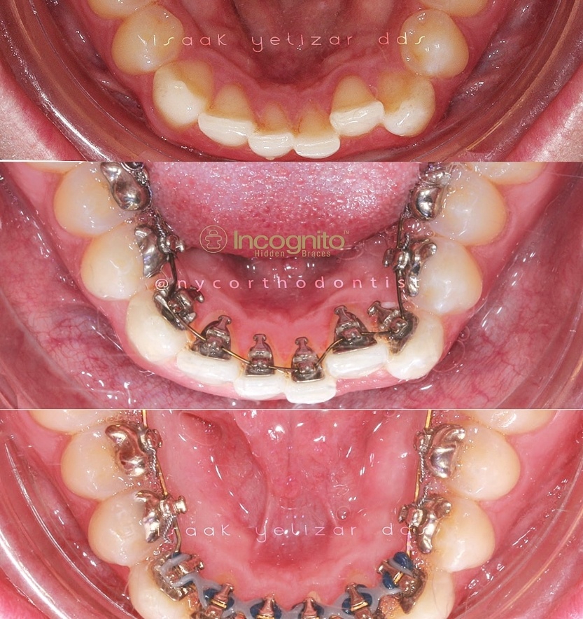 Inside of bottom teeth before during and after orthodontic treatment for severe tooth crowding