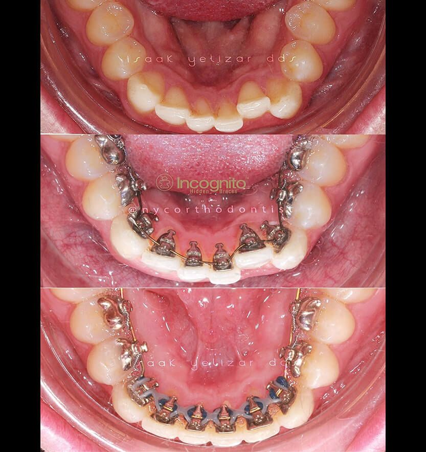 Inside of bottom teeth before during and after orthodontic treatment for severe tooth crowding