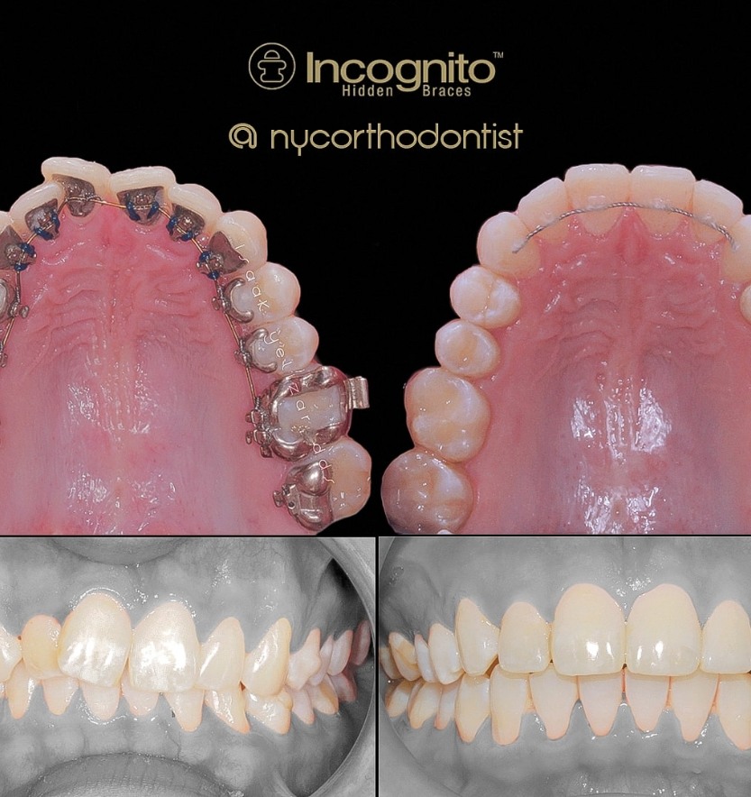 Inside of bottom teeth before during and after incognito braces treatment for crowding