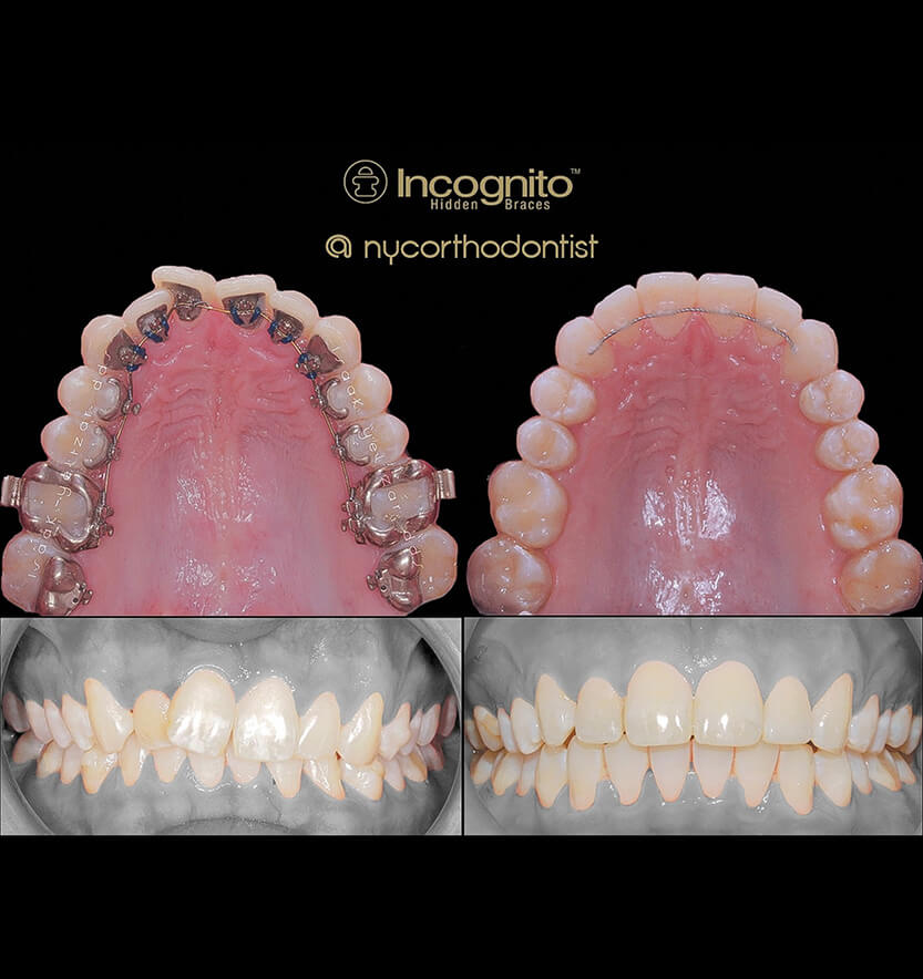 Inside of bottom teeth before during and after incognito braces treatment for crowding