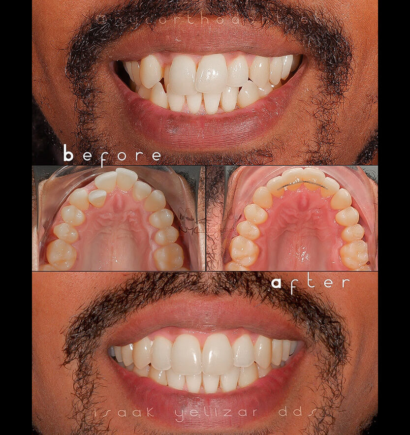 Inside of bottom teeth and front of smile before and after incognito braces treatment for crowding