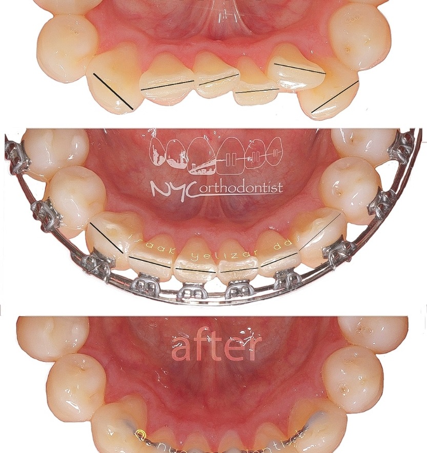 Smile before during and after crowding treatment