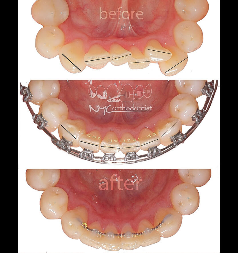 Smile before during and after crowding treatment