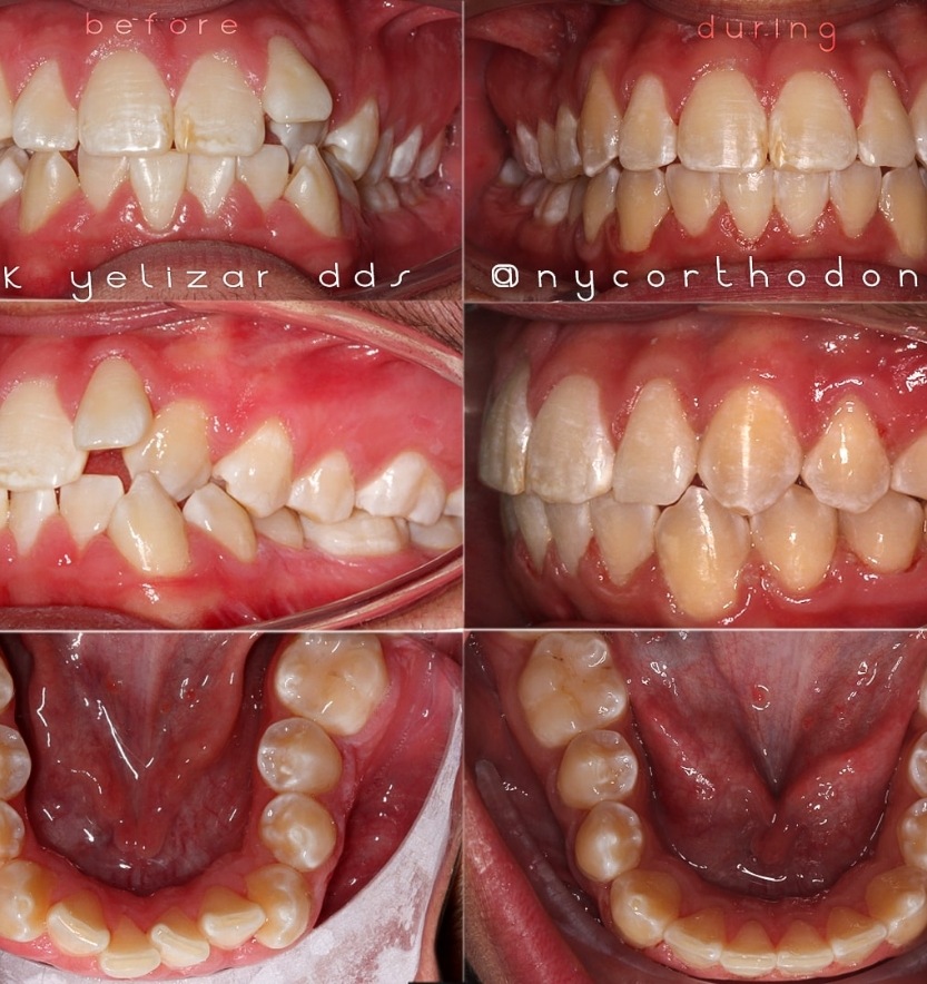 Front of smile and inside of bite before and after orthodontic treatment for crowding