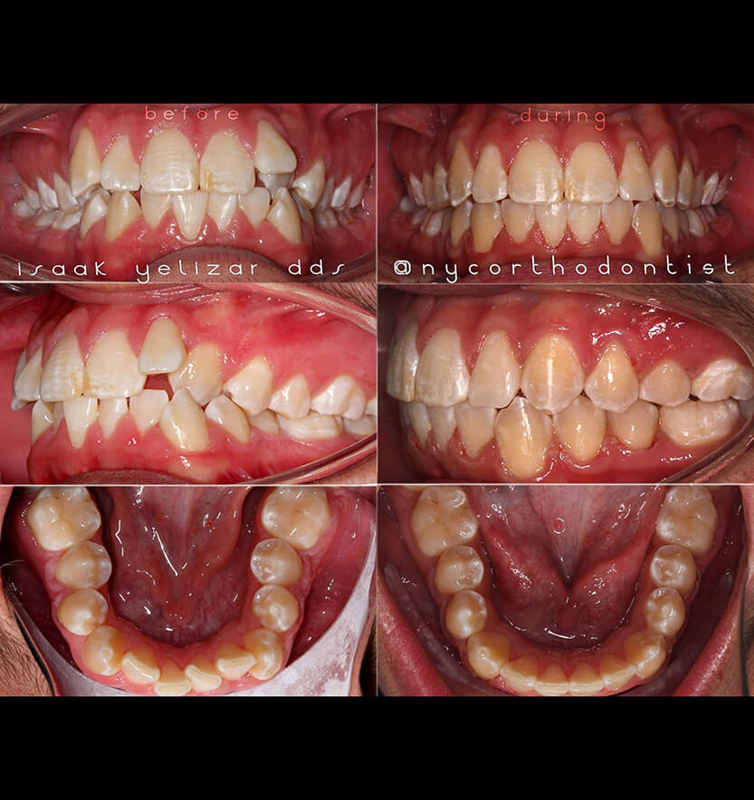 Front of smile and inside of bite before and after orthodontic treatment for crowding
