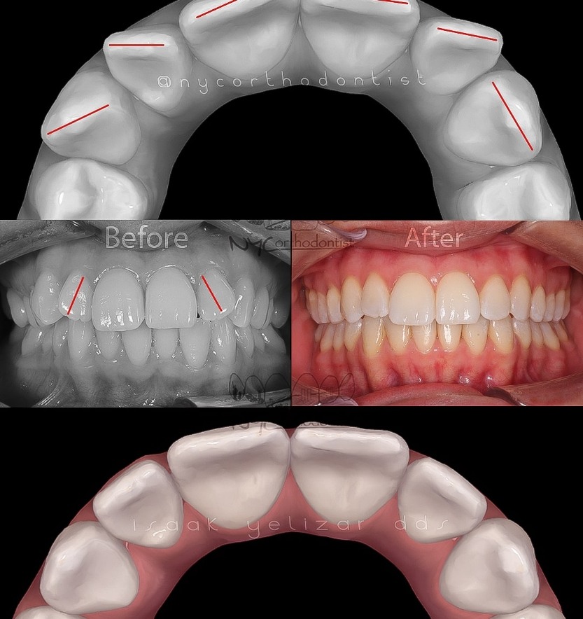 Front and side of smile and inside of bottom teeth before and after orthodontic treatment for crowding