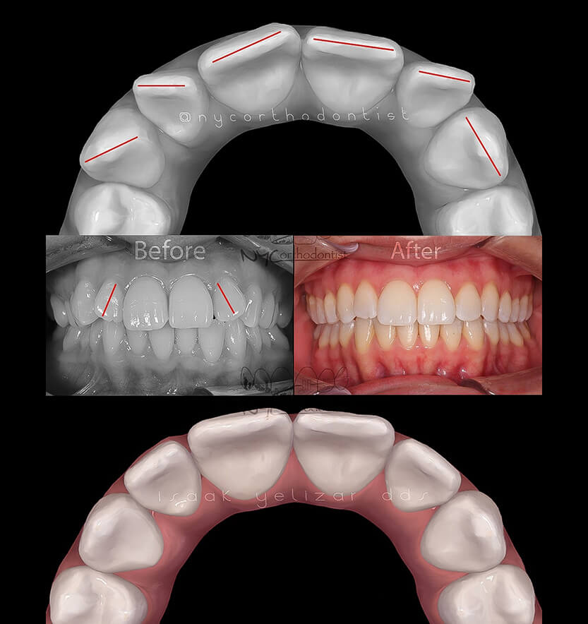 Front and side of smile and inside of bottom teeth before and after orthodontic treatment for crowding