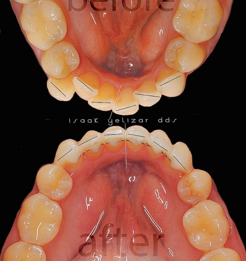 Digital smile design and front of smile before and after orthodontic treatment for crowding