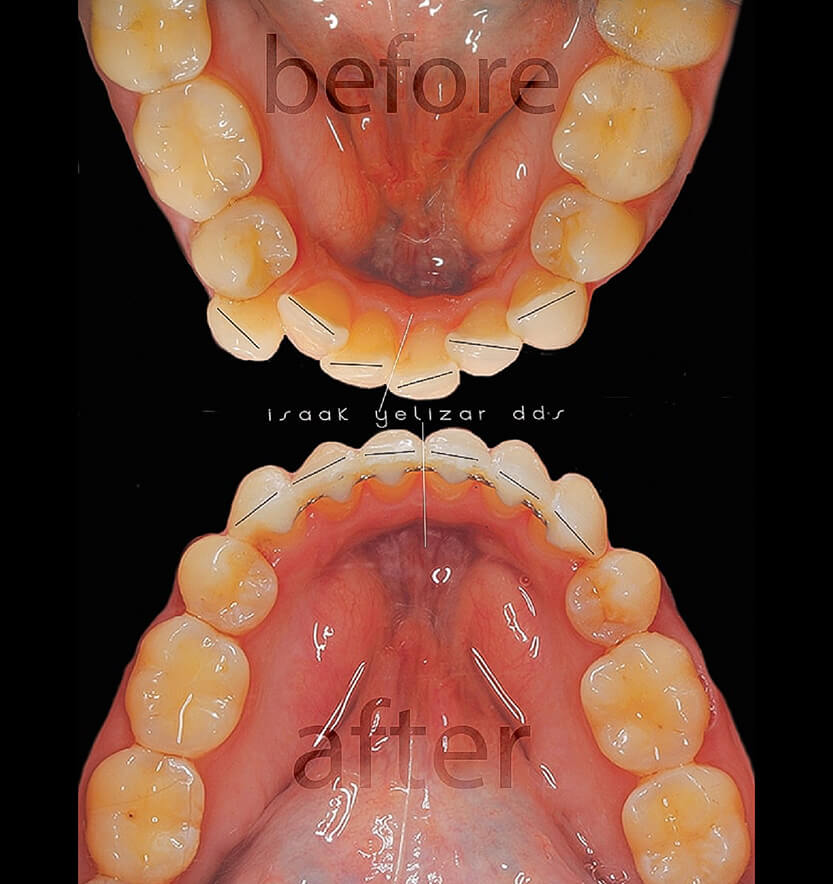 Digital smile design and front of smile before and after orthodontic treatment for crowding