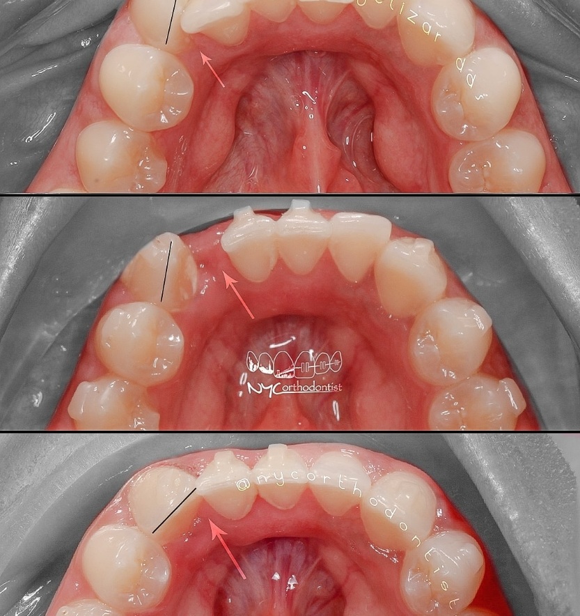 Inside of bottome teeth before and after orthodontic treatment for crowding