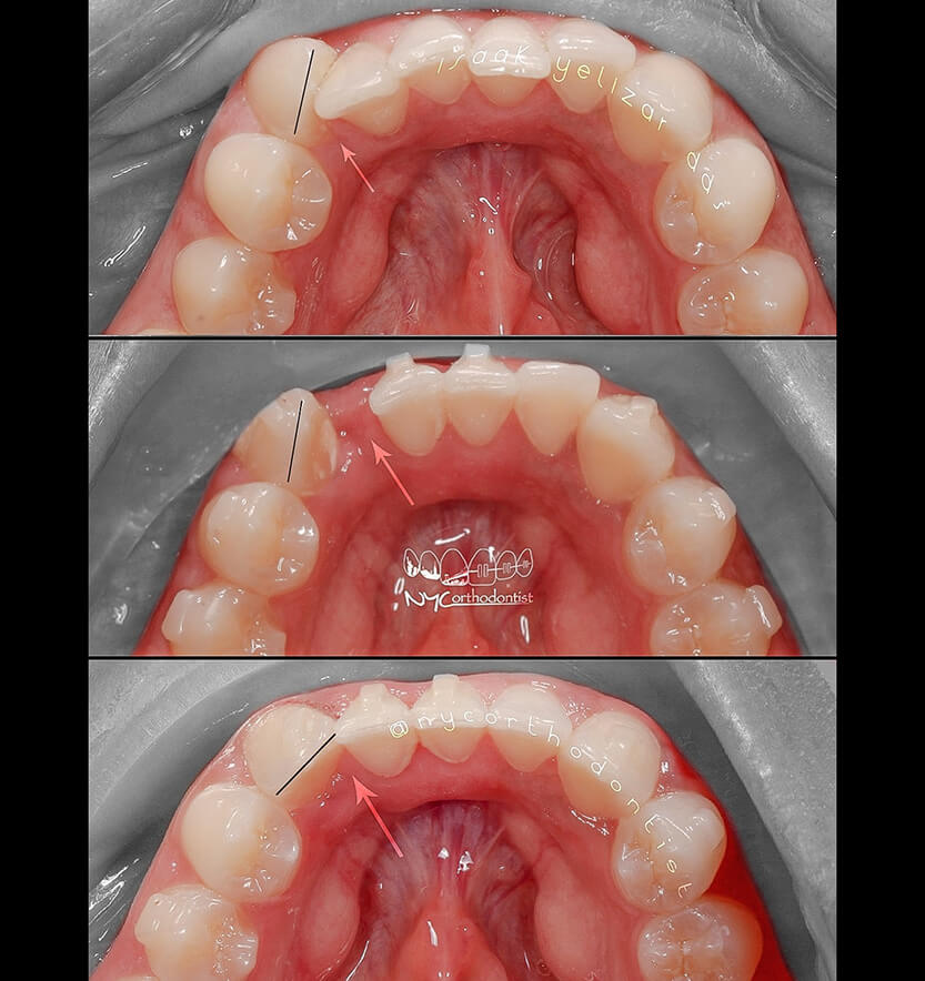 Inside of bottome teeth before and after orthodontic treatment for crowding
