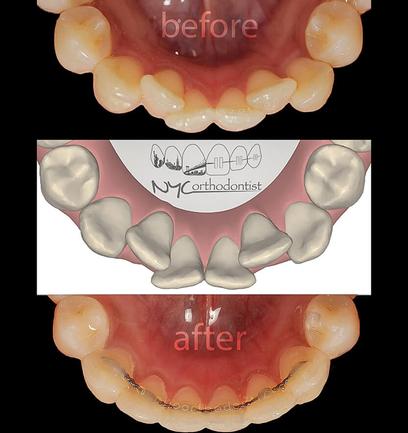 Inside of bottom teeth before during and after orthodontic treatment for crowding