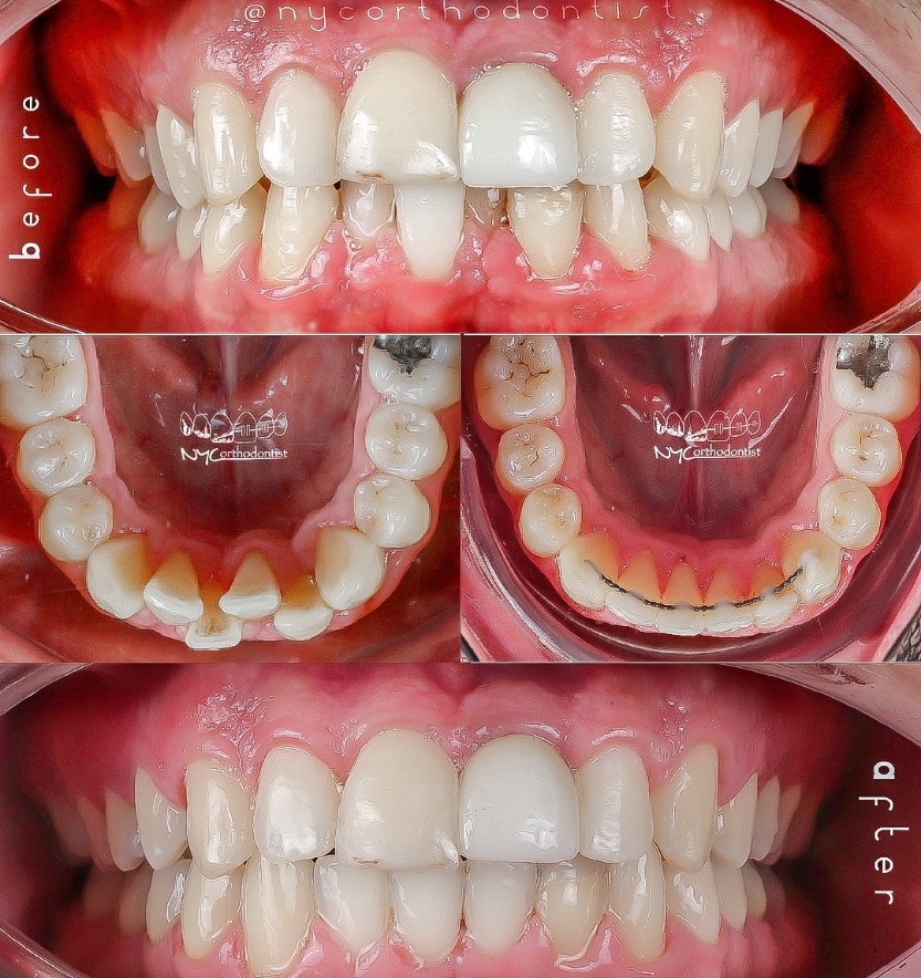 Digital smile design and inside of bottom teeth before and after orthodontic treatment for crowding