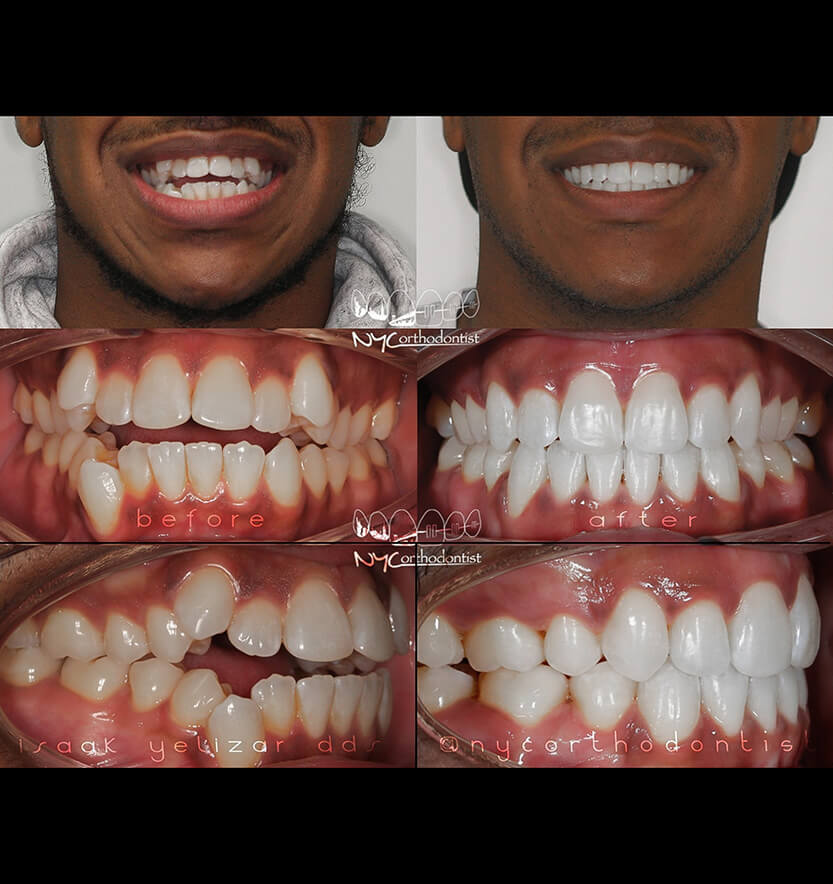 Front view of smile and inside bottom teeth before and after orthodontic treatment for crowding