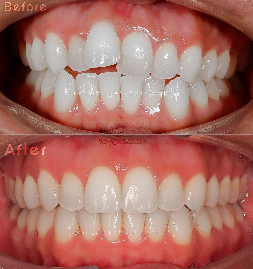 Sides and front of smile before and after orthodontic treatment for crowding