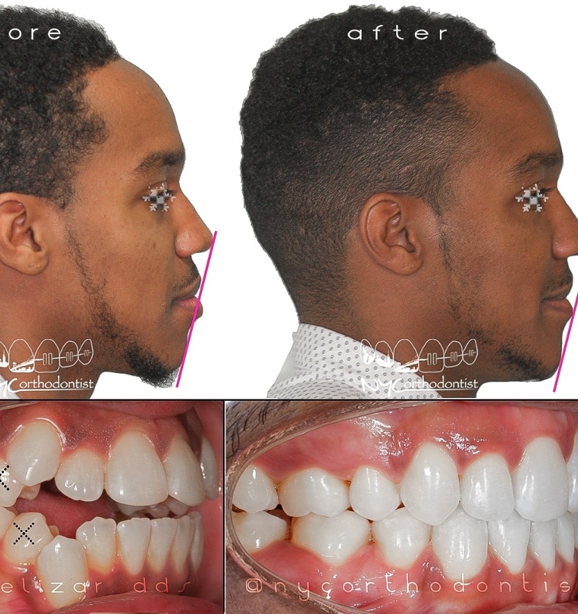 Side and front view of patient's smile before and after orthodontic treatment for crowding