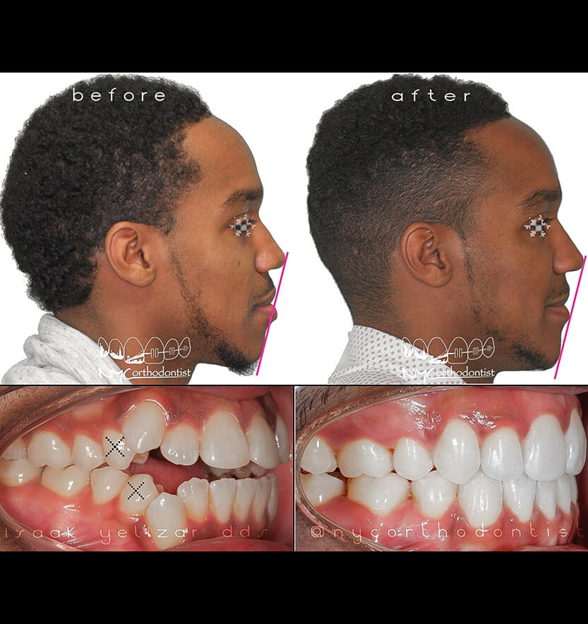 Side and front view of patient's smile before and after orthodontic treatment for crowding