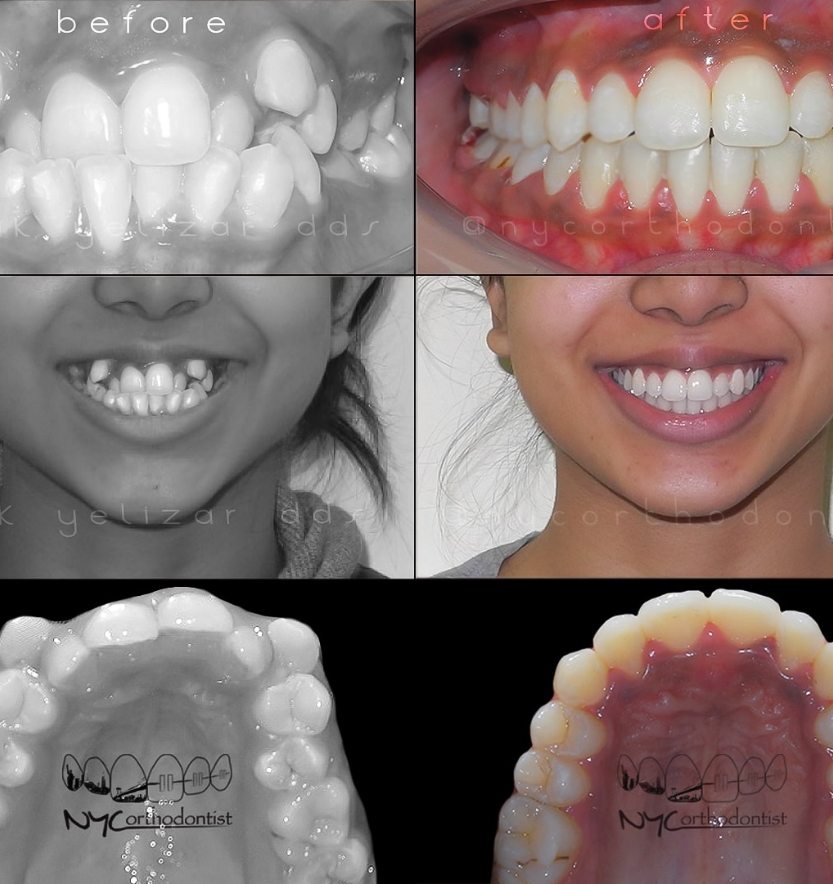 Front of patient's smile before and after treatment for crowding