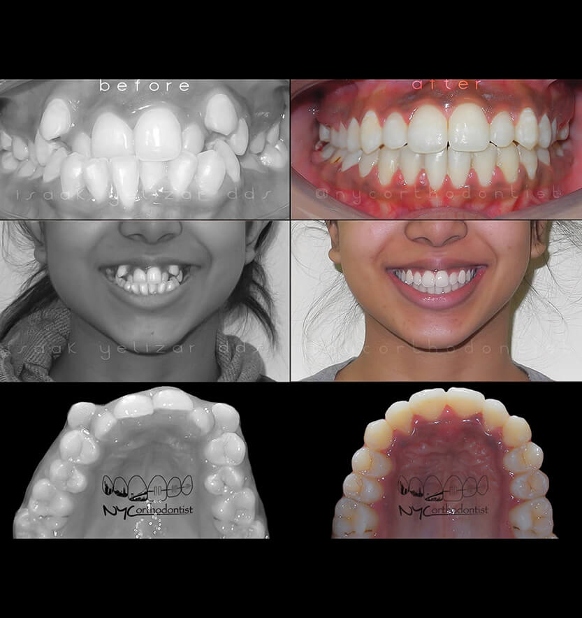 Front of patient's smile before and after treatment for crowding