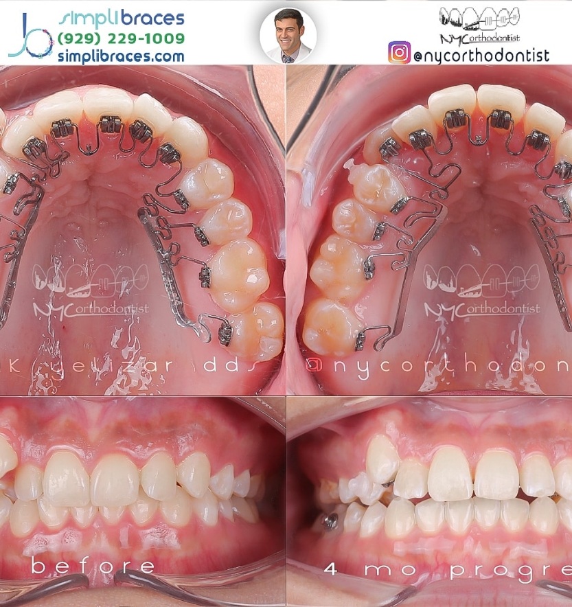 Patient's smile before and after crowding treatment