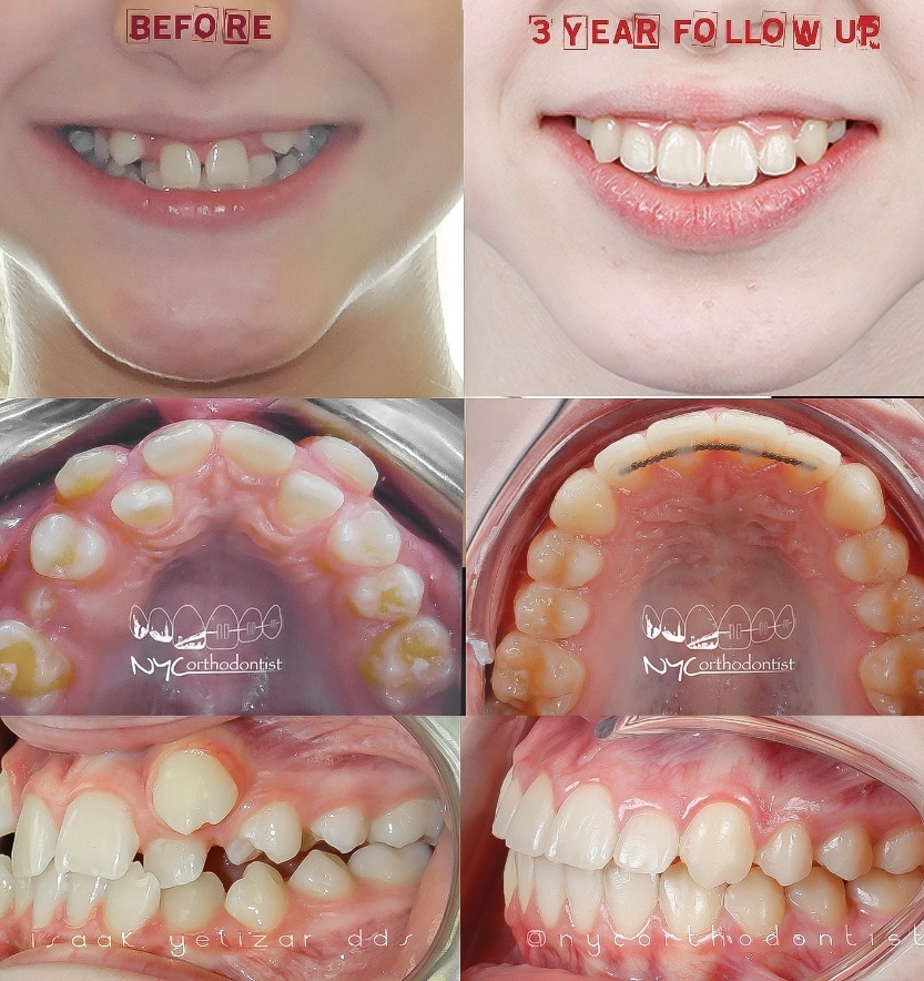 Patient's smile before and after treatment for crowding