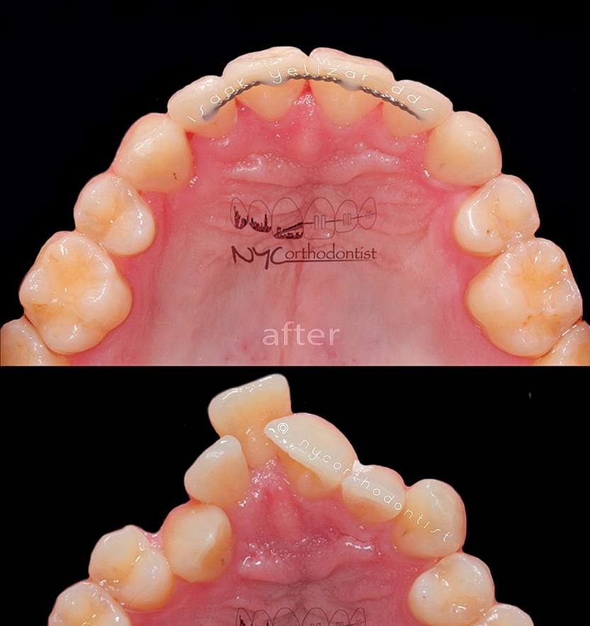 Front and inside of patient's smile before and after treatment for crowding