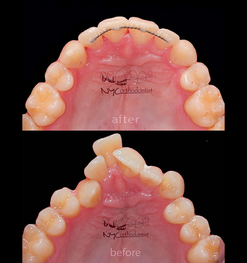 Front and inside of patient's smile before and after treatment for crowding