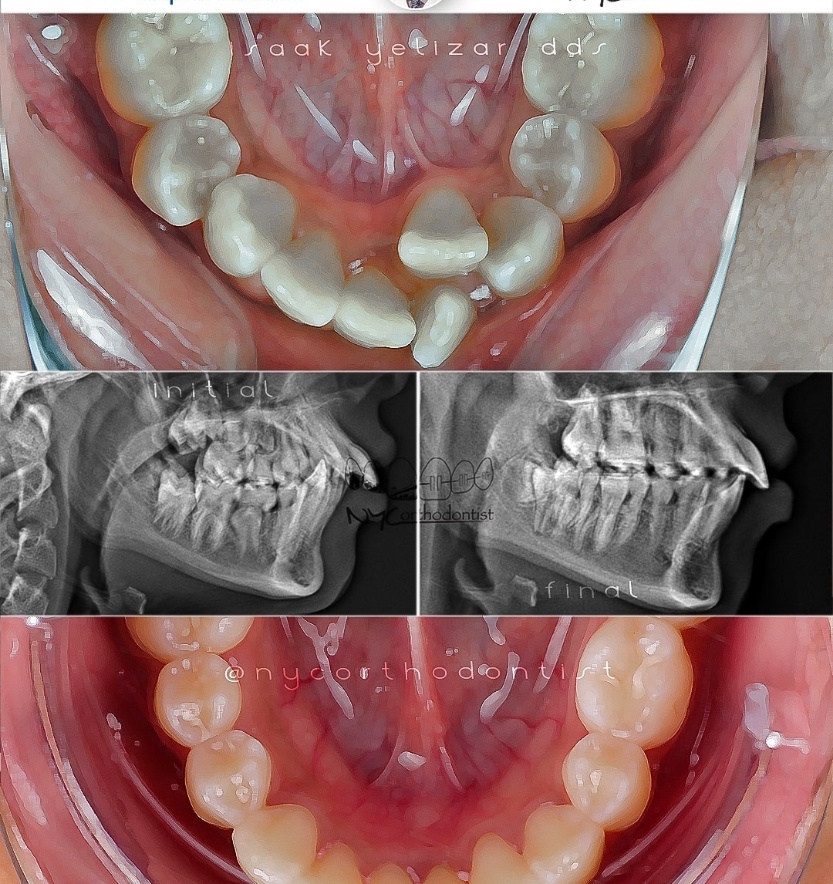 Front and side of patient's smile before and after treatment for crowding