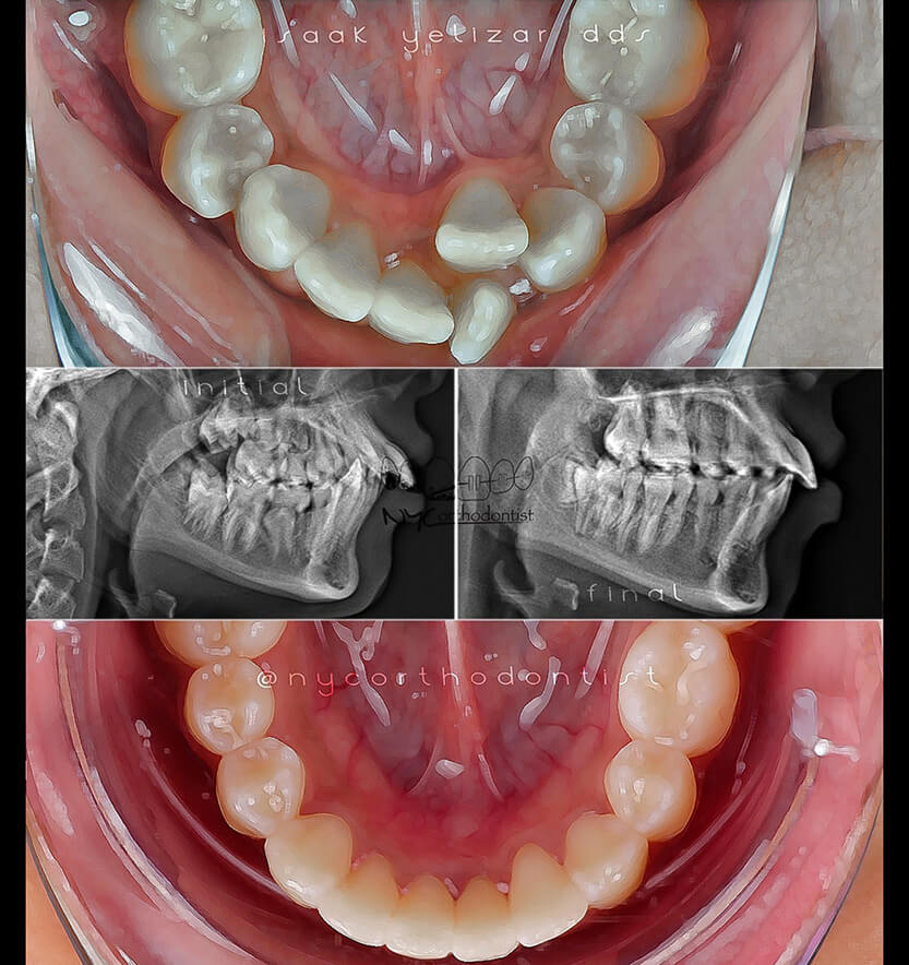 Front and side of patient's smile before and after treatment for crowding