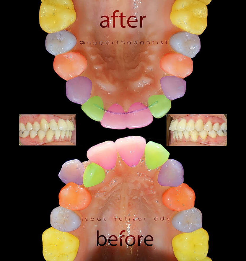 Inside of bottom teeth and x-ray of smile before and after treatment for crowding