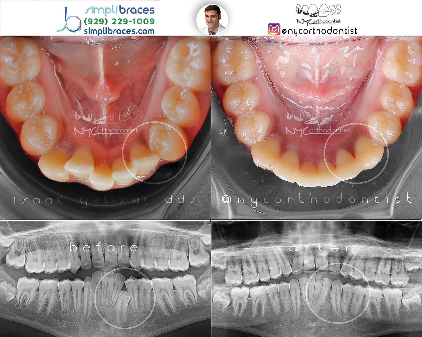 Inside of bottom teeth and x-ray of profile before and after treatment for crowding