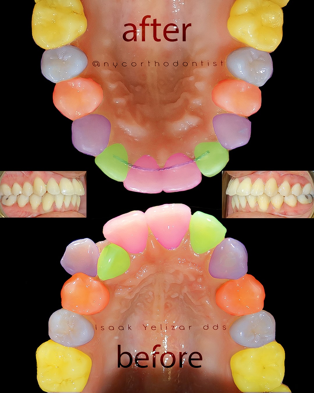 Inside of bottom teeth and profile of smile before and after treatment for crowding