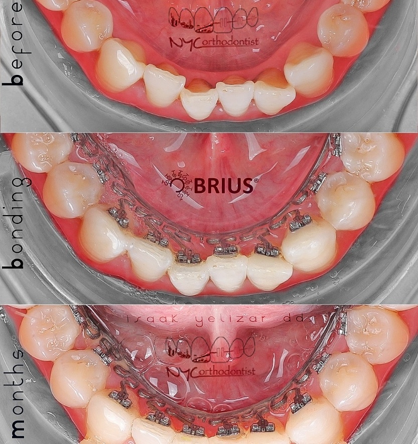 Smile before during and after Brius crowding treatment