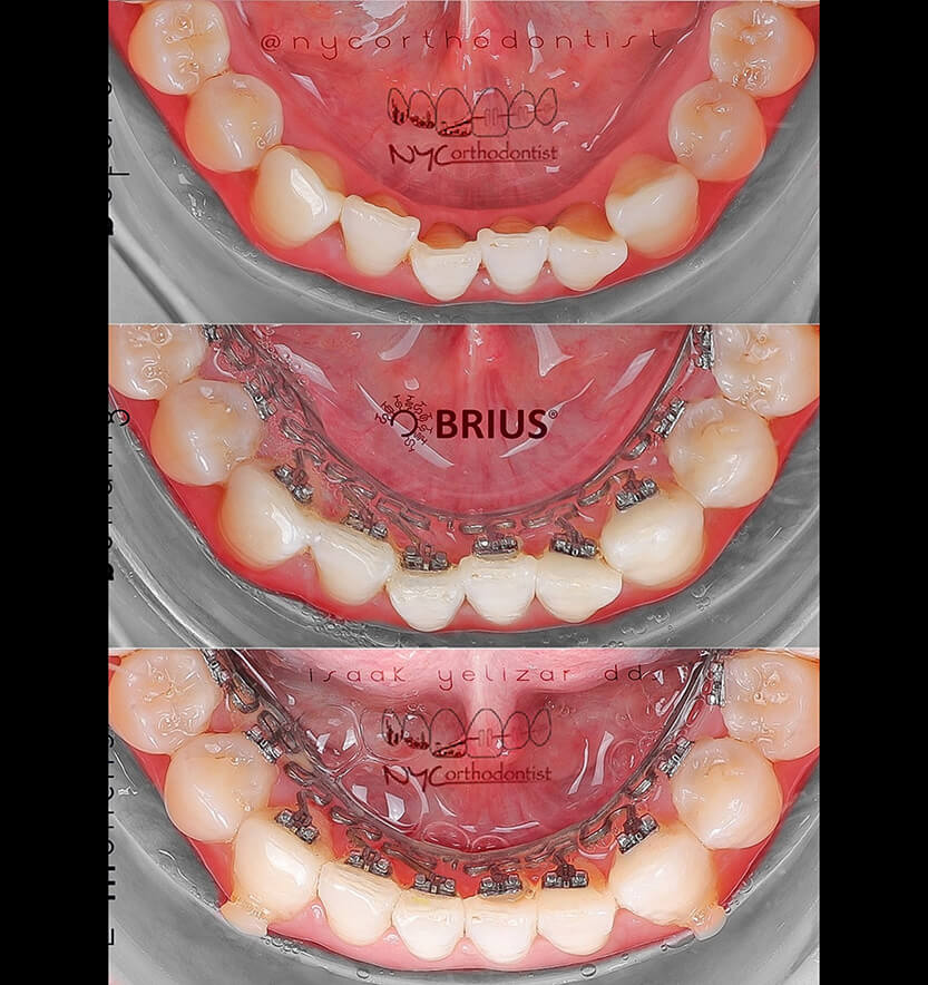 Smile before during and after Brius crowding treatment