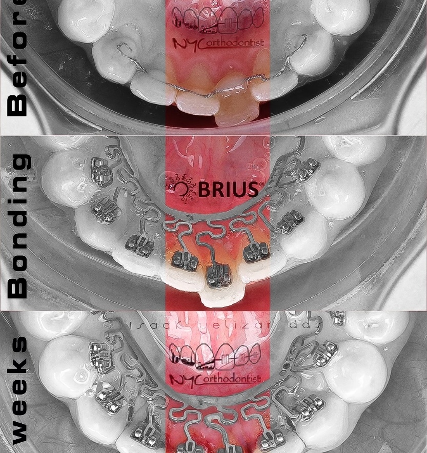 Inside of bottom teeth before during and after crowding treatment
