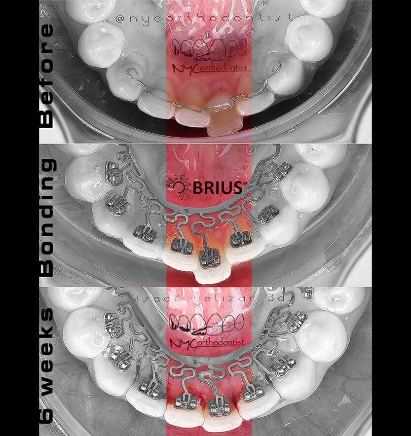 Inside of bottom teeth before during and after crowding treatment