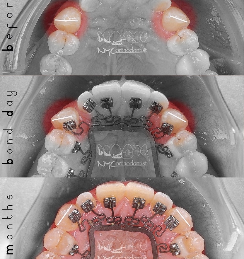 Inside of bottom teeth before during and after crowding treatment