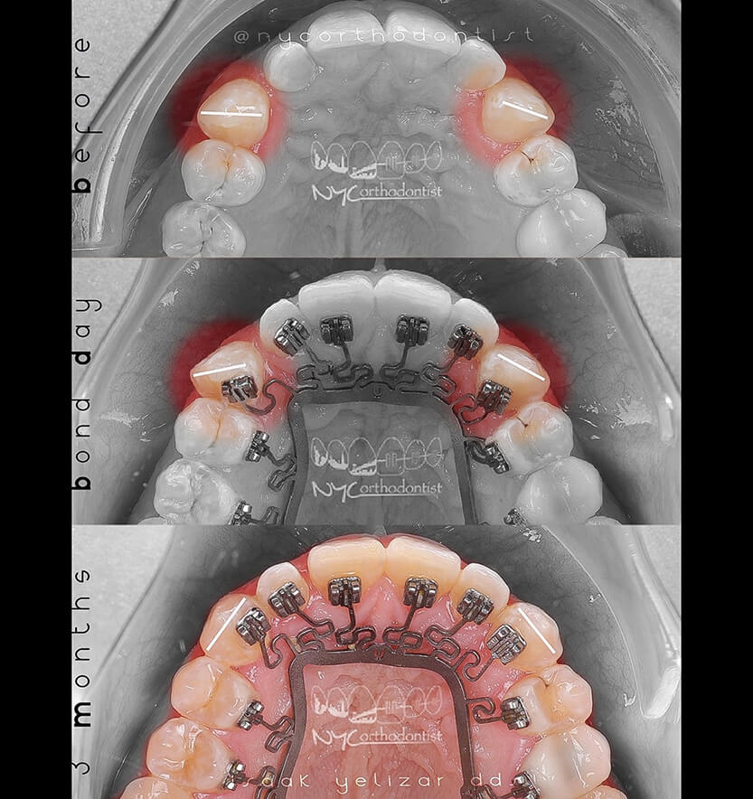 Inside of bottom teeth before during and after crowding treatment