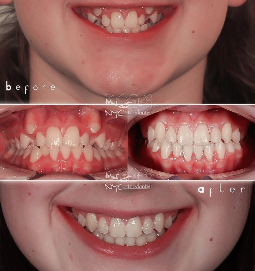 Front of smile before and after crowding treatment