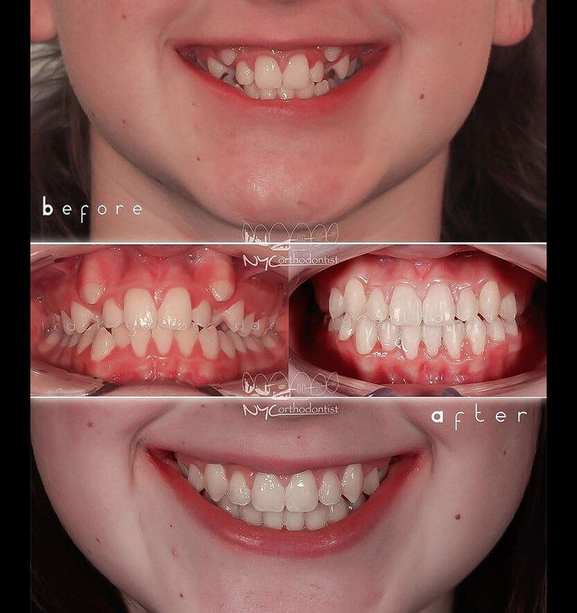 Front of smile before and after crowding treatment