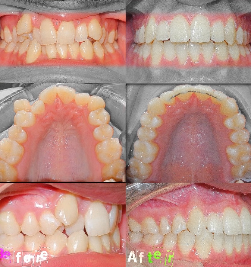 Front and side view of smile and inside of bottom teeth before and after crowding treatment